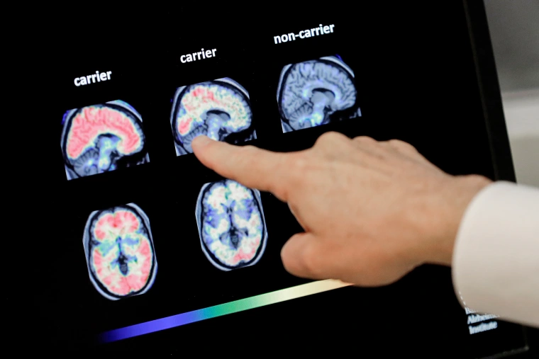 Alzheimer blood test Helps Detect Early Dementia In Recent Cases