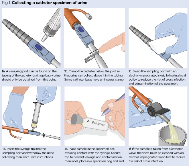 Catheter Urine Sample Collection Procedure for NMC OSCE Exam