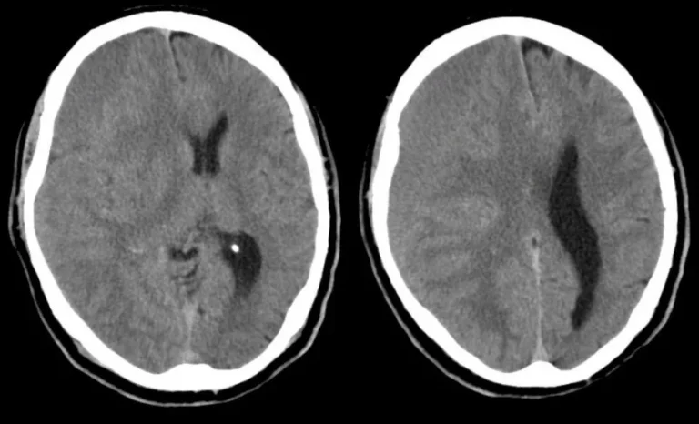 2024 OSCE Planning: Subdural Haematoma