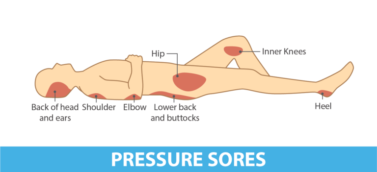 Pressure Area Assessment in the NMC OSCE